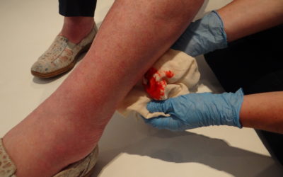 Bleeding and Skin Ulceration
